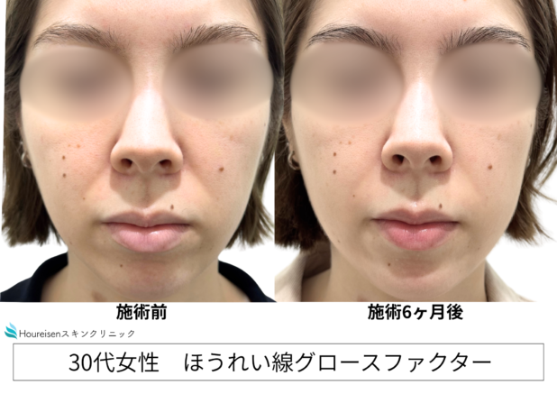 30代女性 症例55のほうれい線治療写真