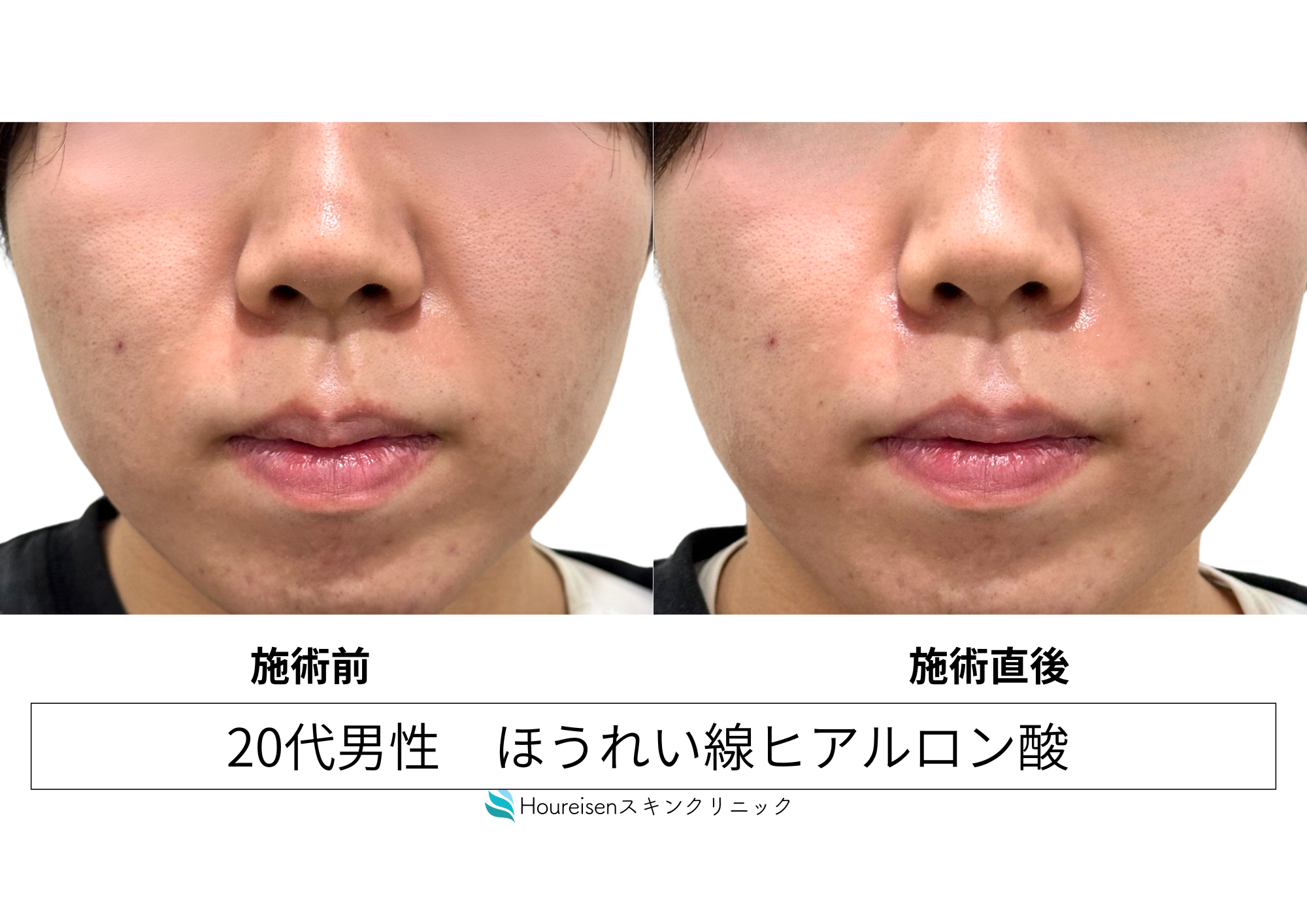 ヒアルロン酸注射で気になるほうれい線改善 20代男性症例㊻の症例写真