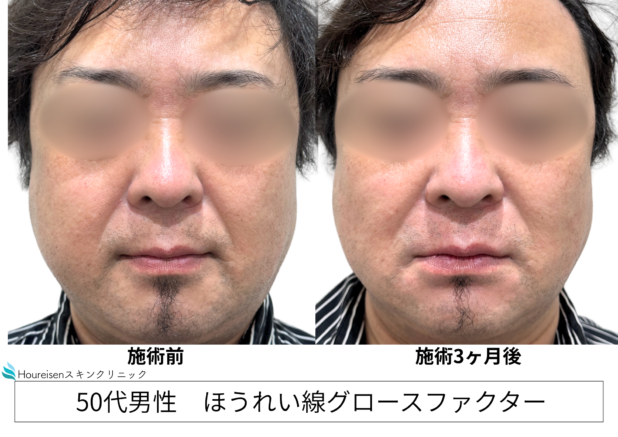 50代男性 症例11のほうれい線治療写真