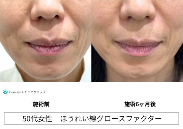 50代女性 症例43のほうれい線治療写真