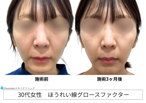 30代女性 症例61のほうれい線治療写真