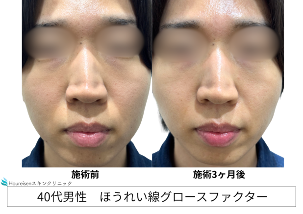 40代男性 症例11のほうれい線治療写真