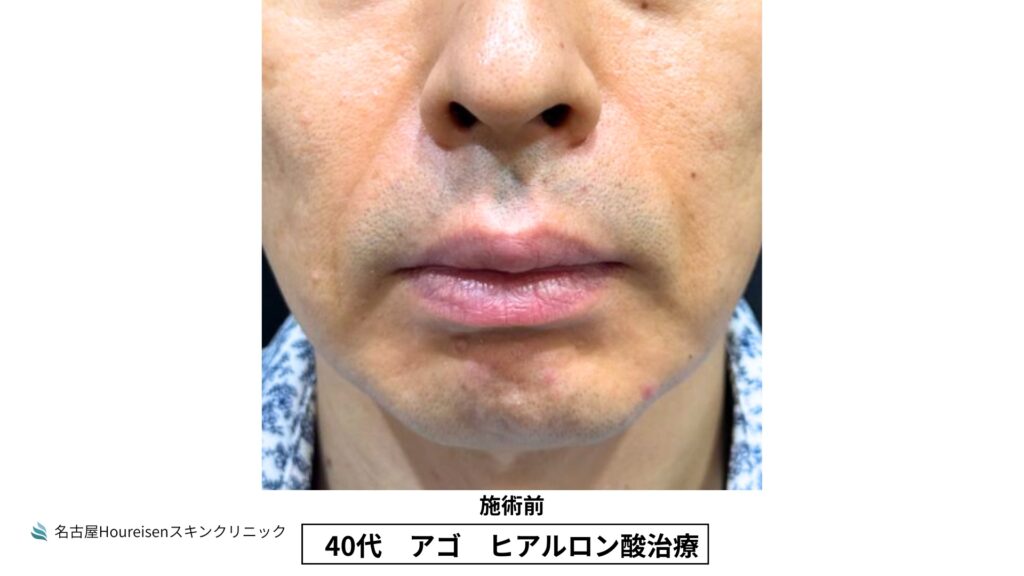40代男性の顎ヒアルロン酸治療 施術前 VIEW 02