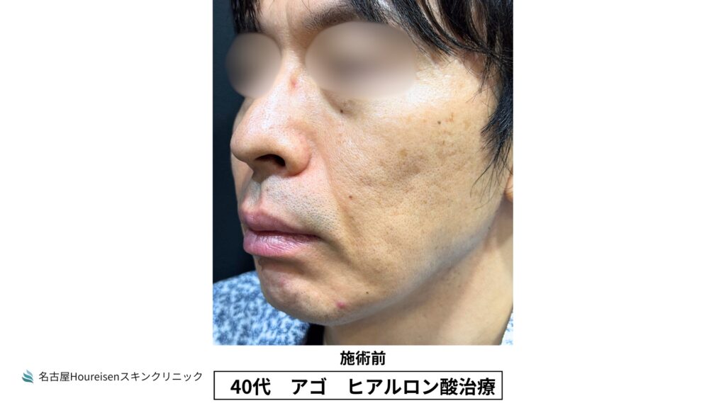 40代男性の顎ヒアルロン酸治療 施術前 VIEW 03