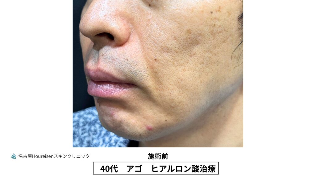 40代男性の顎ヒアルロン酸治療 施術前 VIEW 04