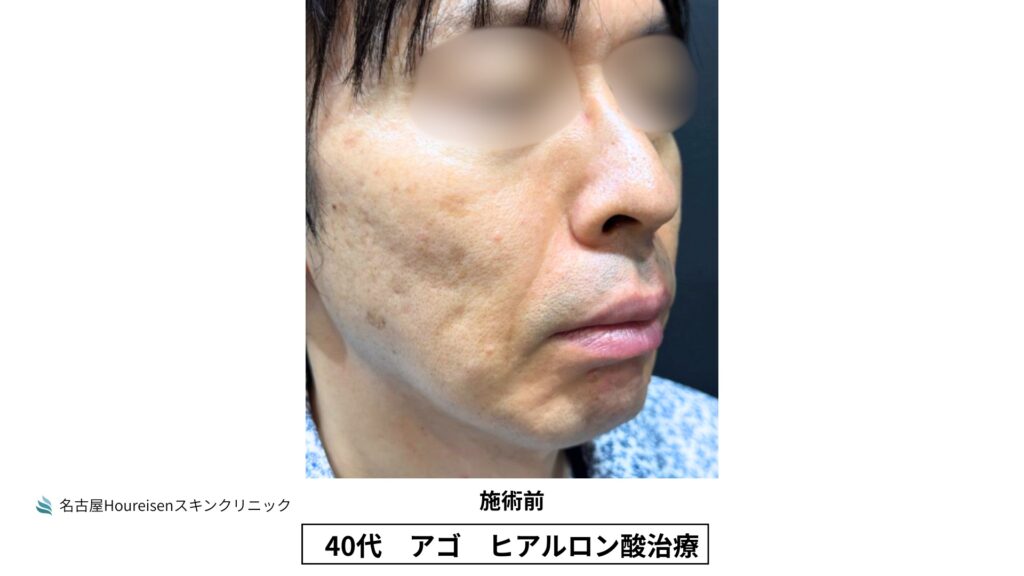40代男性の顎ヒアルロン酸治療 施術前 VIEW 05