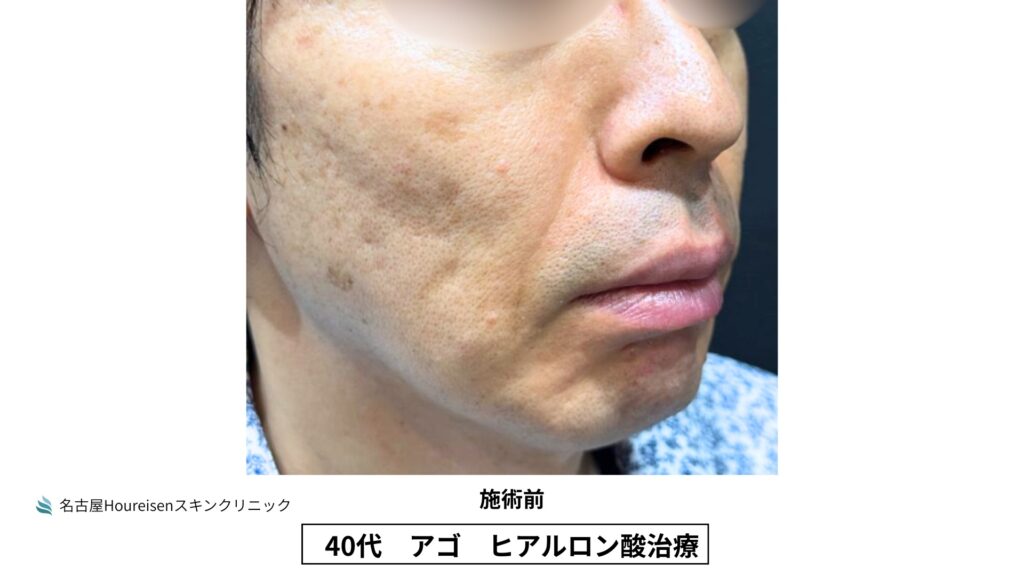40代男性の顎ヒアルロン酸治療 施術前 VIEW 06
