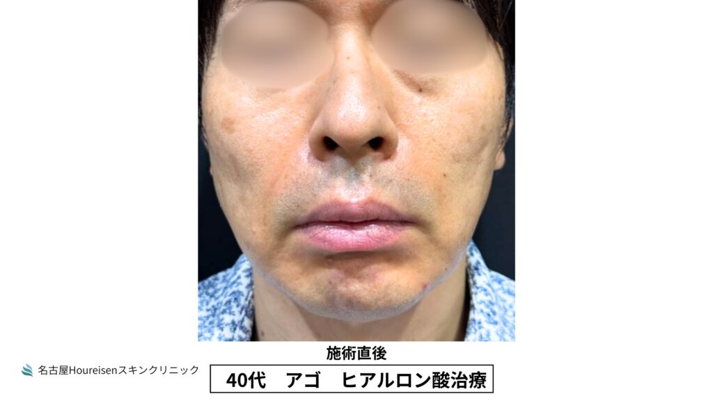 40代男性の顎ヒアルロン酸治療 施術直後 VIEW 01