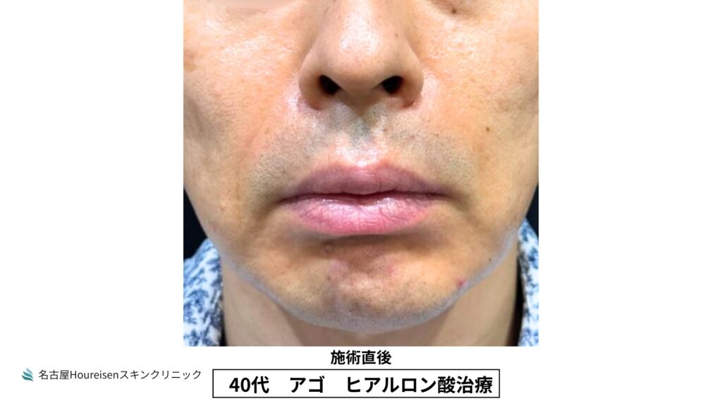 40代男性の顎ヒアルロン酸治療 施術直後 VIEW 02