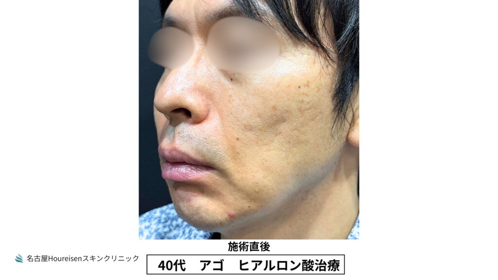 40代男性の顎ヒアルロン酸治療 施術直後 VIEW 03