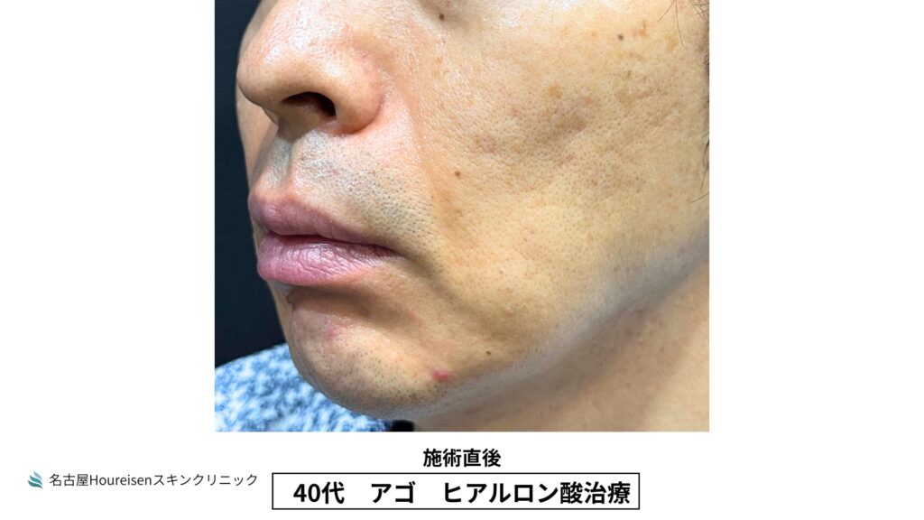 40代男性の顎ヒアルロン酸治療 施術直後 VIEW 04