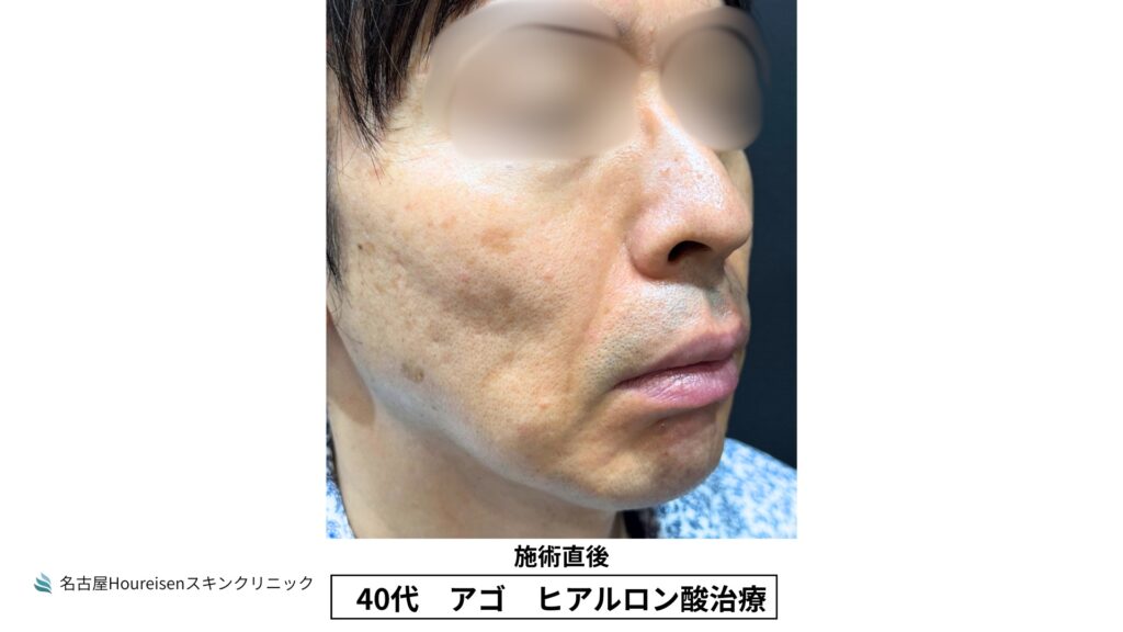 40代男性の顎ヒアルロン酸治療 施術直後 VIEW 05
