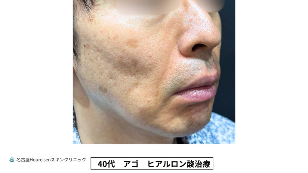40代男性の顎ヒアルロン酸治療 施術直後 VIEW 06