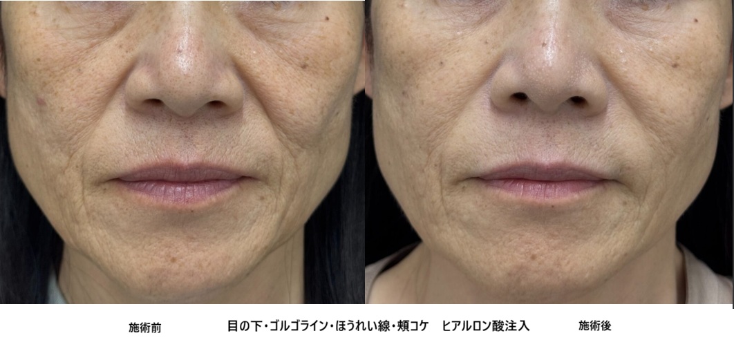 60歳代　ほうれい線・目の下・ゴルゴライン・頬こけをヒアルロン酸でトータル改善⑫の症例写真