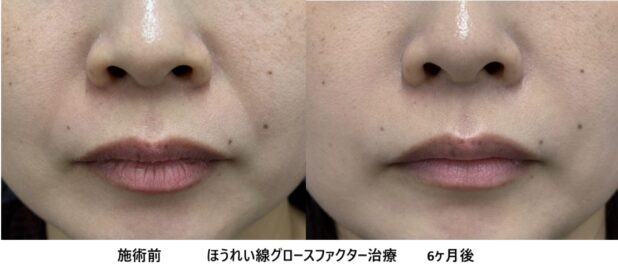 30代女性 症例67のほうれい線治療写真