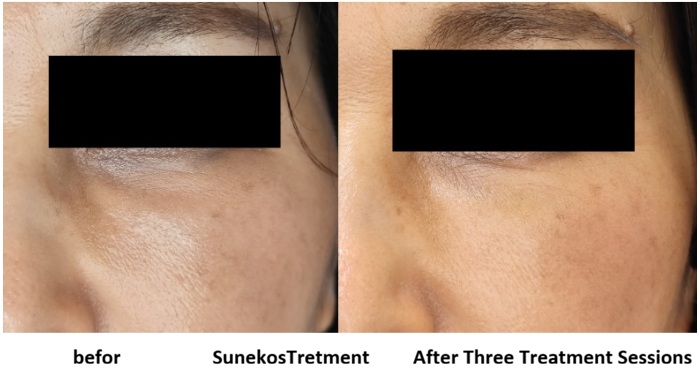 Before-and-after result of Sunekos treatment for the under-eye area