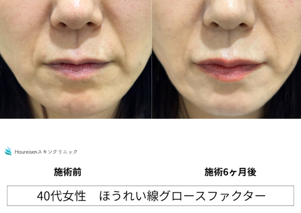 40代女性 症例61のほうれい線治療写真