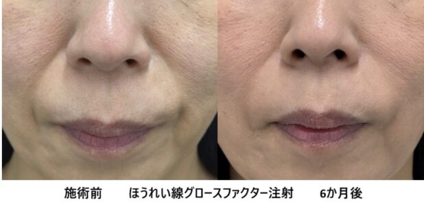 50代女性 症例51のほうれい線治療写真