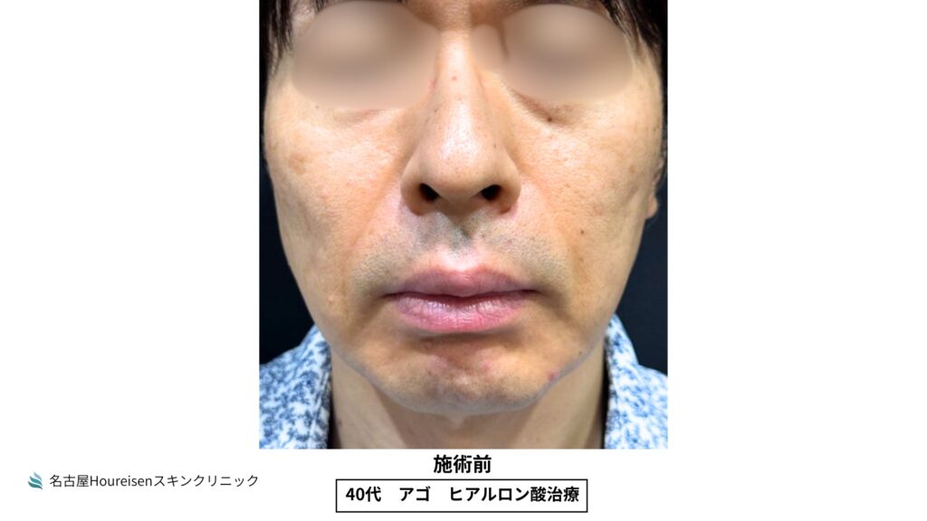 40代男性の顎ヒアルロン酸治療 施術前 VIEW 01