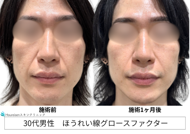 30代男性 症例15のほうれい線治療写真