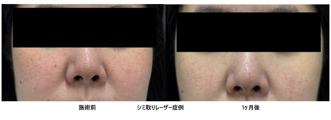 レーザーで全顔のシミ・そばかすを除去した症例⑩の症例写真