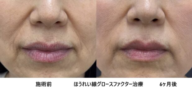60代女性 症例15のほうれい線治療写真