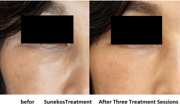 Clinical result after Sunekos treatment for under-eye skin quality