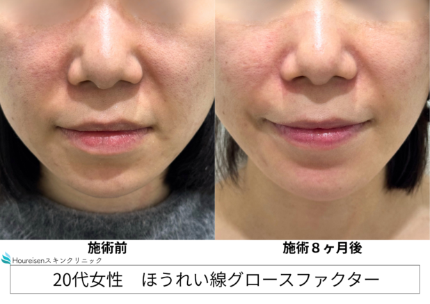 20代女性 症例23のほうれい線治療写真
