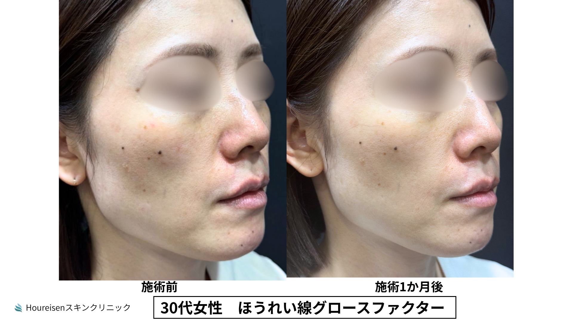 ほうれい線治療 症例比較