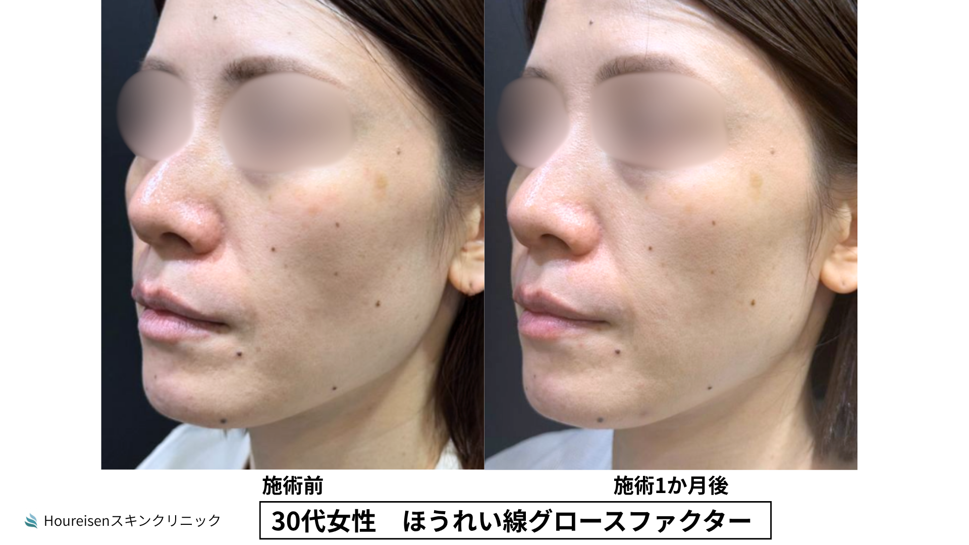 ほうれい線治療 症例比較