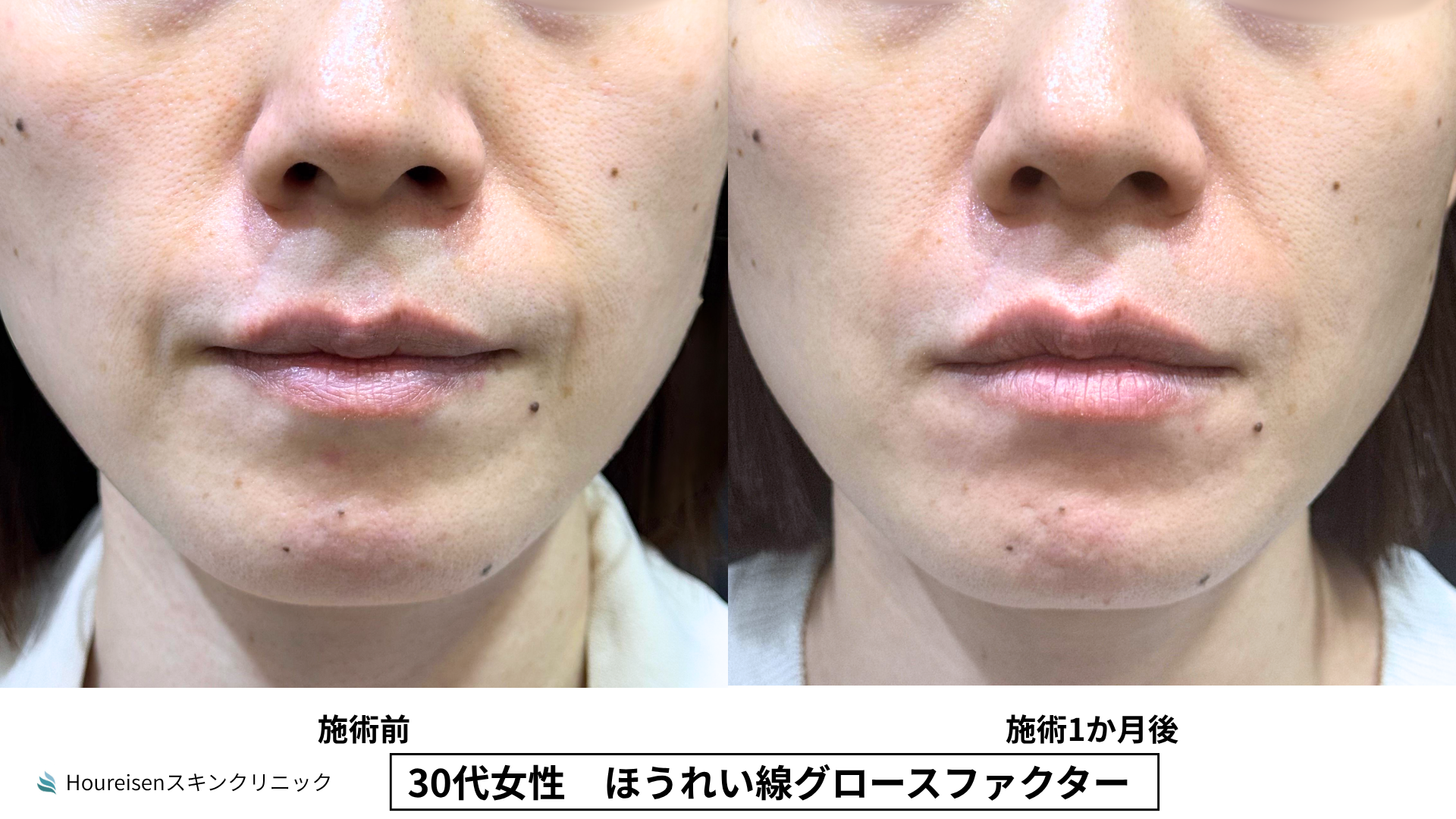 ほうれい線治療 症例比較