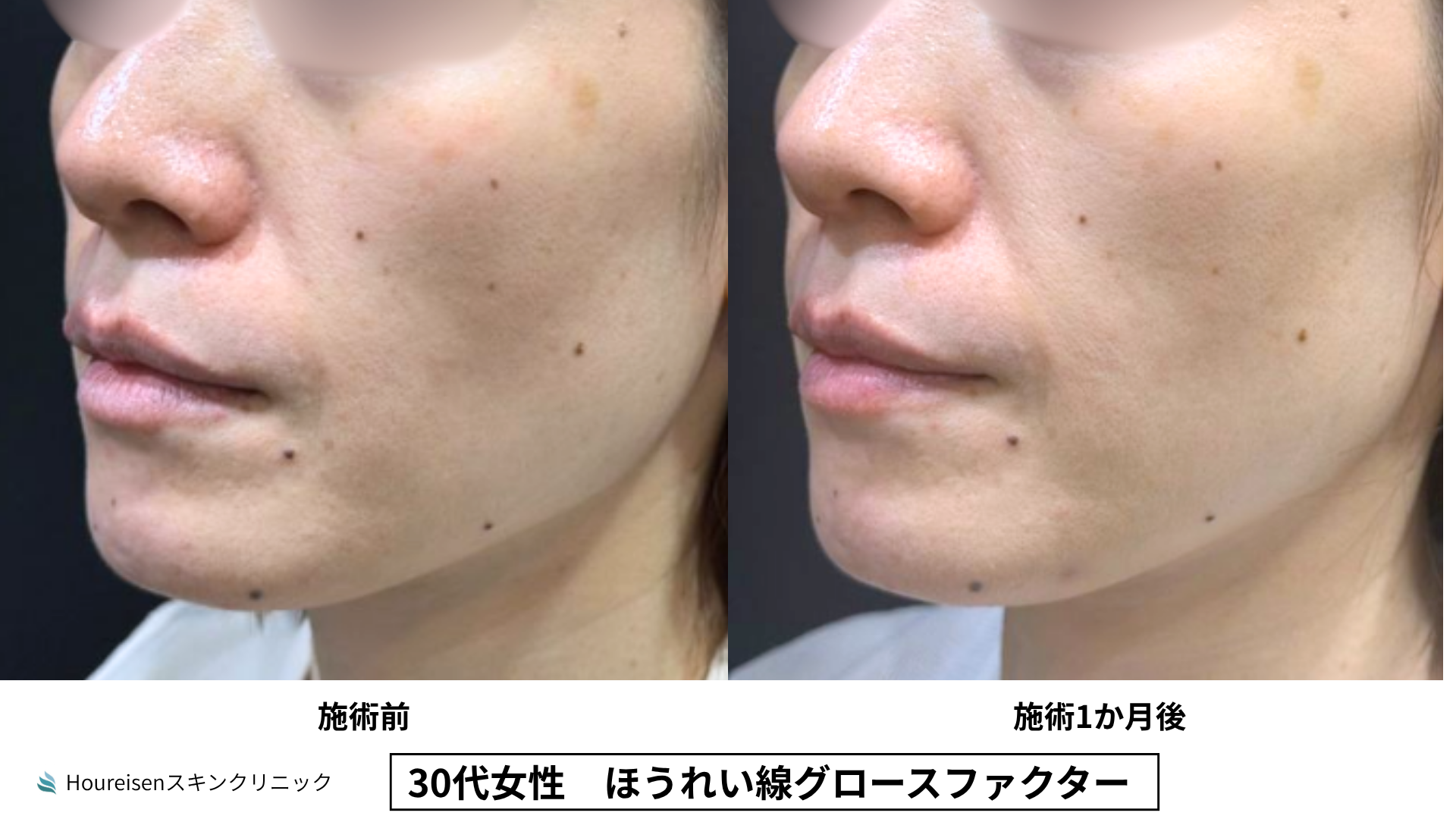 ほうれい線治療 症例比較