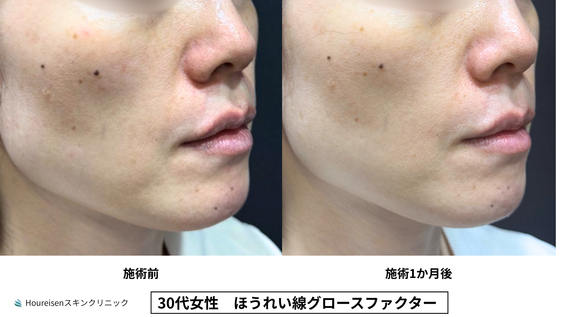 ほうれい線治療 症例比較