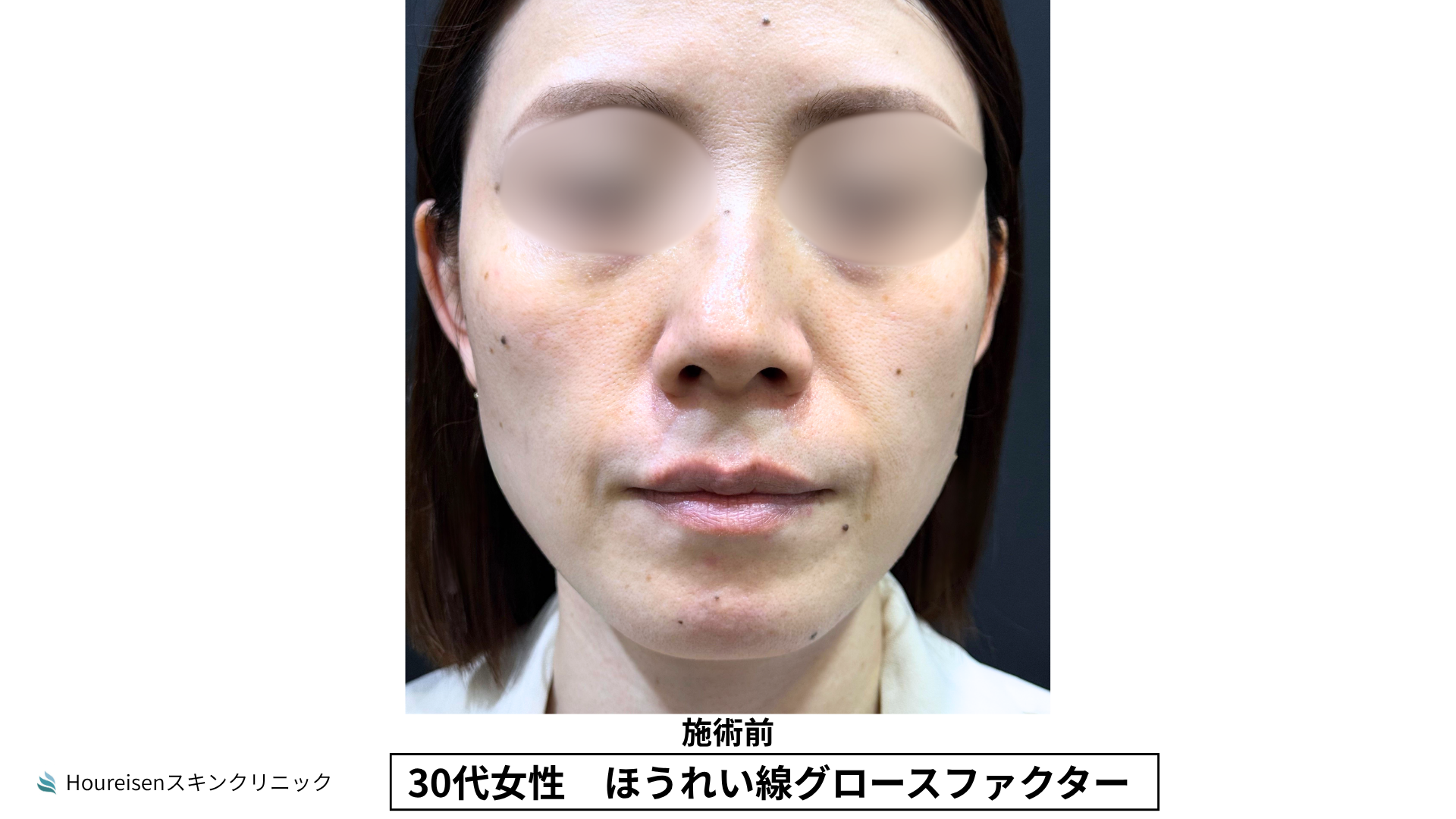ほうれい線施術前