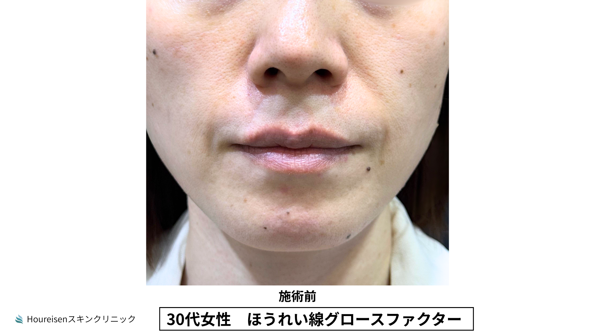 ほうれい線施術前