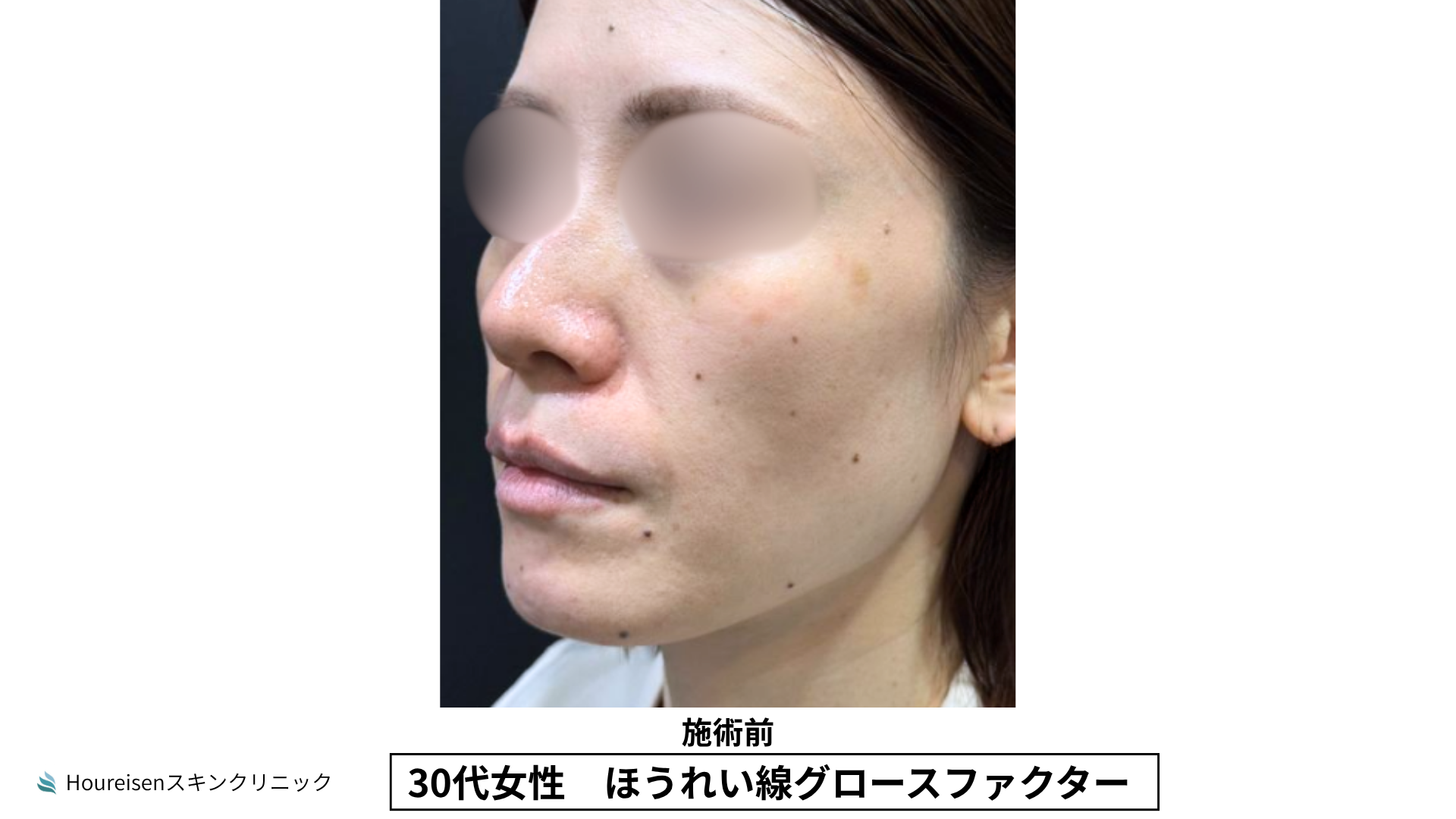 ほうれい線施術前