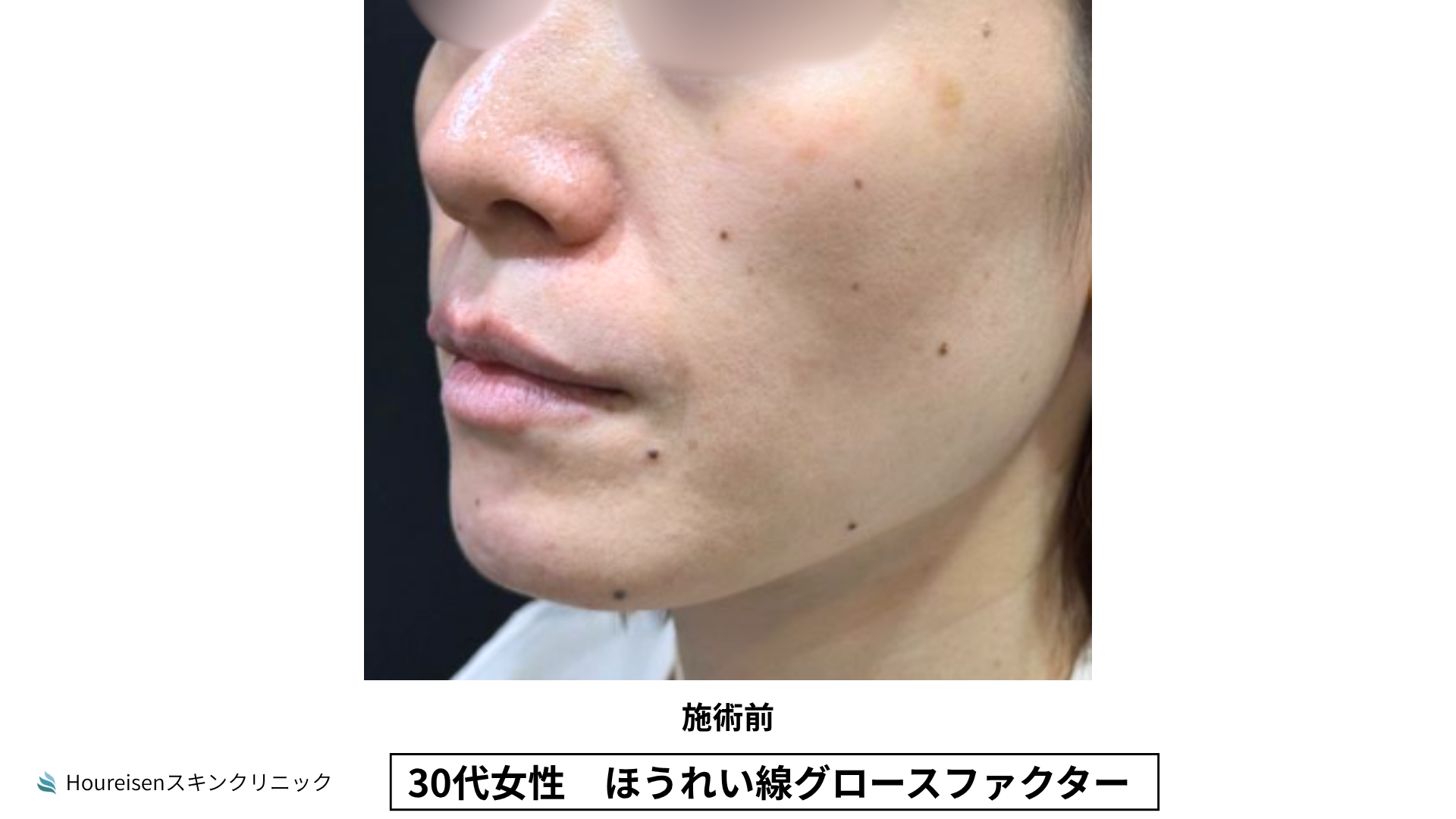 ほうれい線施術前