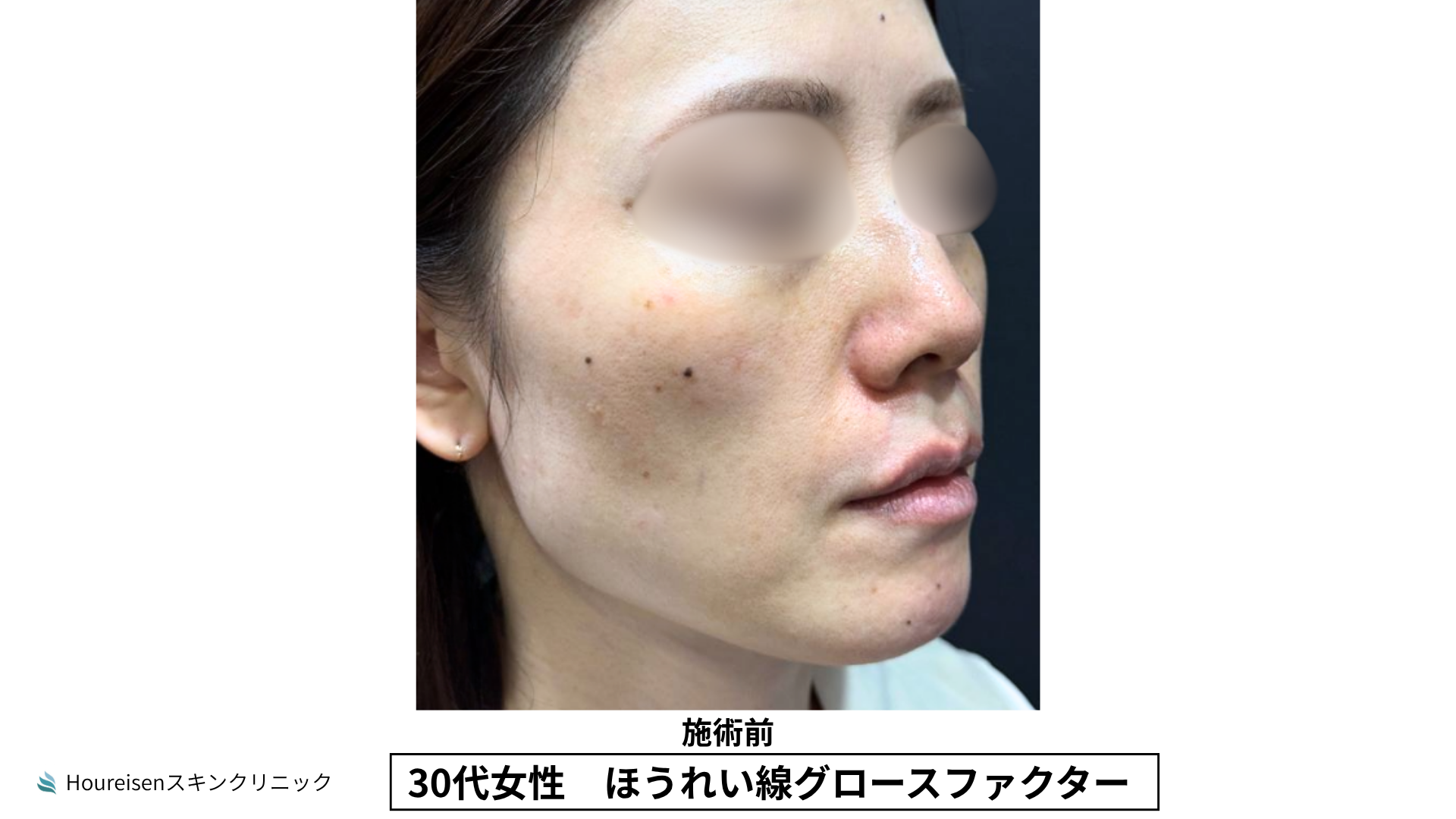 ほうれい線施術前