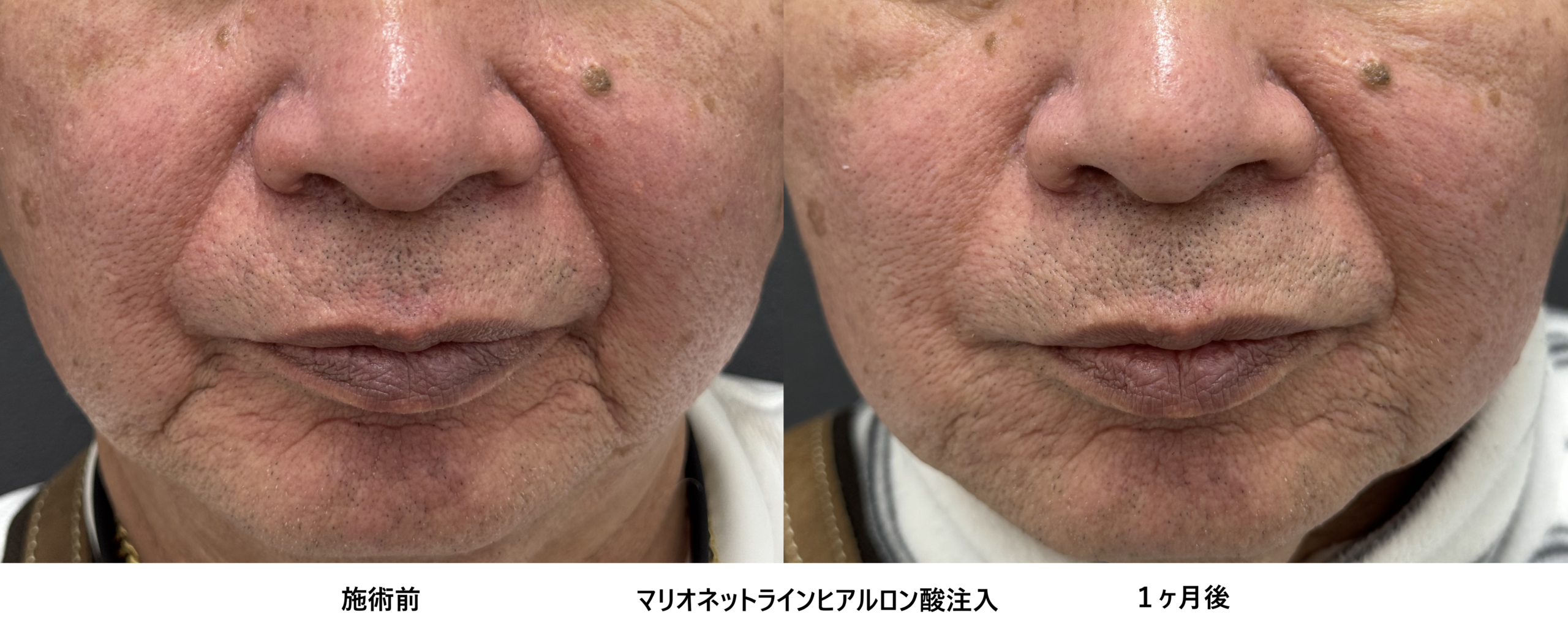 70代男性の強固なマリオネットラインも諦めない！ヒアルロン酸による治療⑦の症例写真