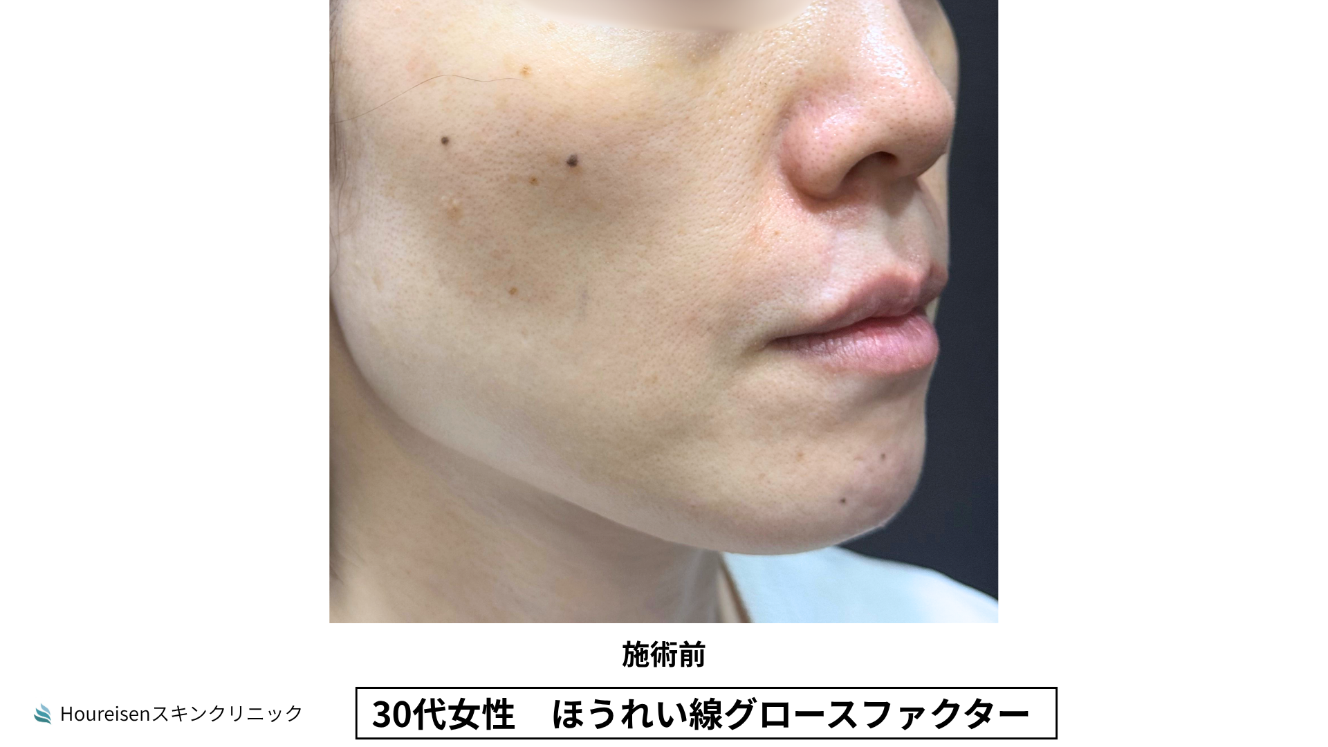 ほうれい線施術前