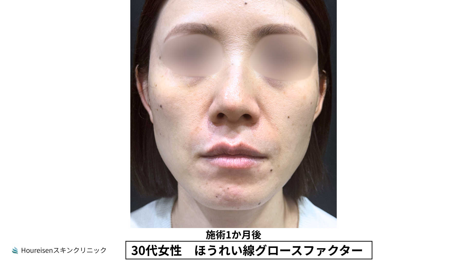 ほうれい線施術1か月後