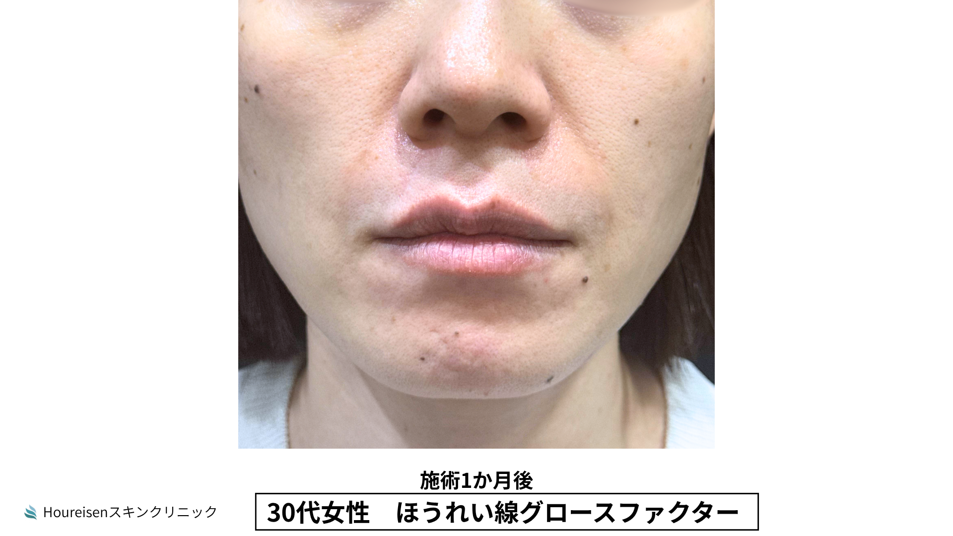 ほうれい線施術1か月後