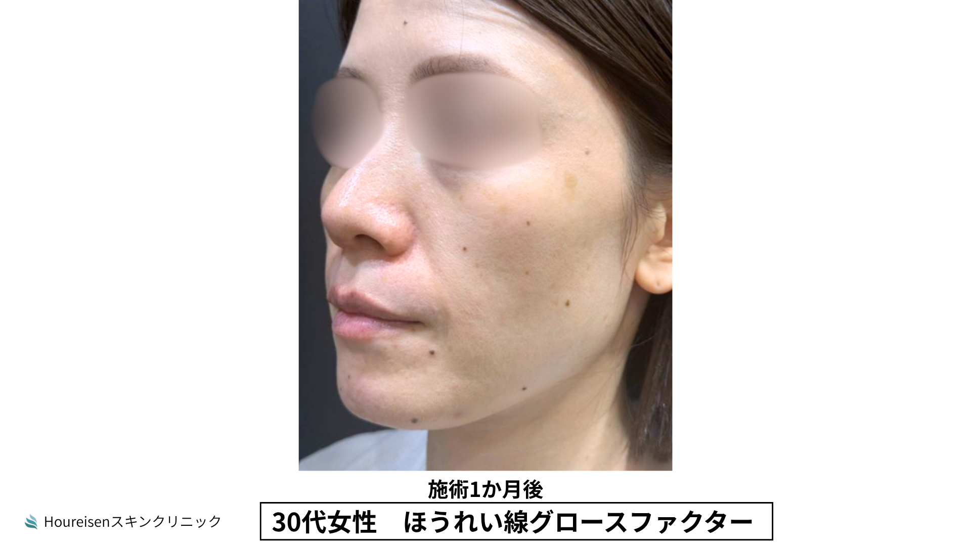 ほうれい線施術1か月後