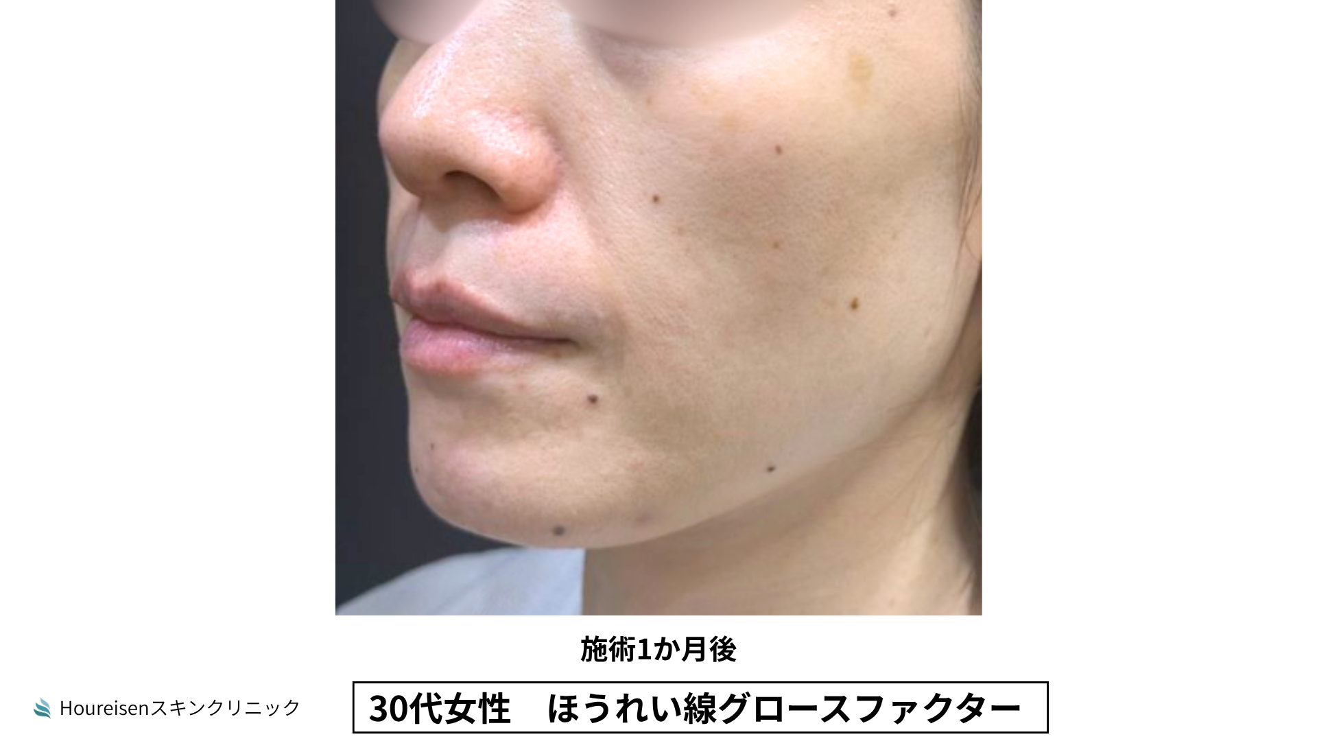ほうれい線施術1か月後