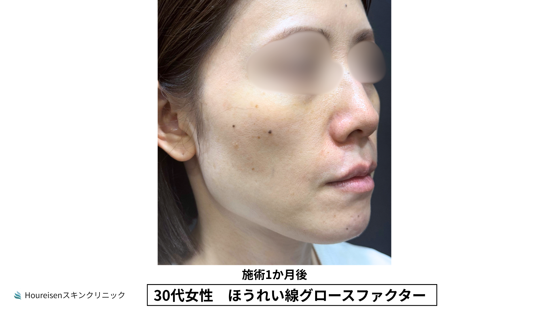 ほうれい線施術1か月後