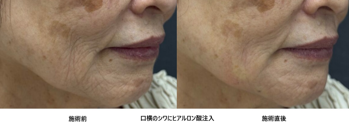 口元の小じわが気になる方へ｜ヒアルロン酸でなめらかに整え若々しい印象に⑪の症例写真
