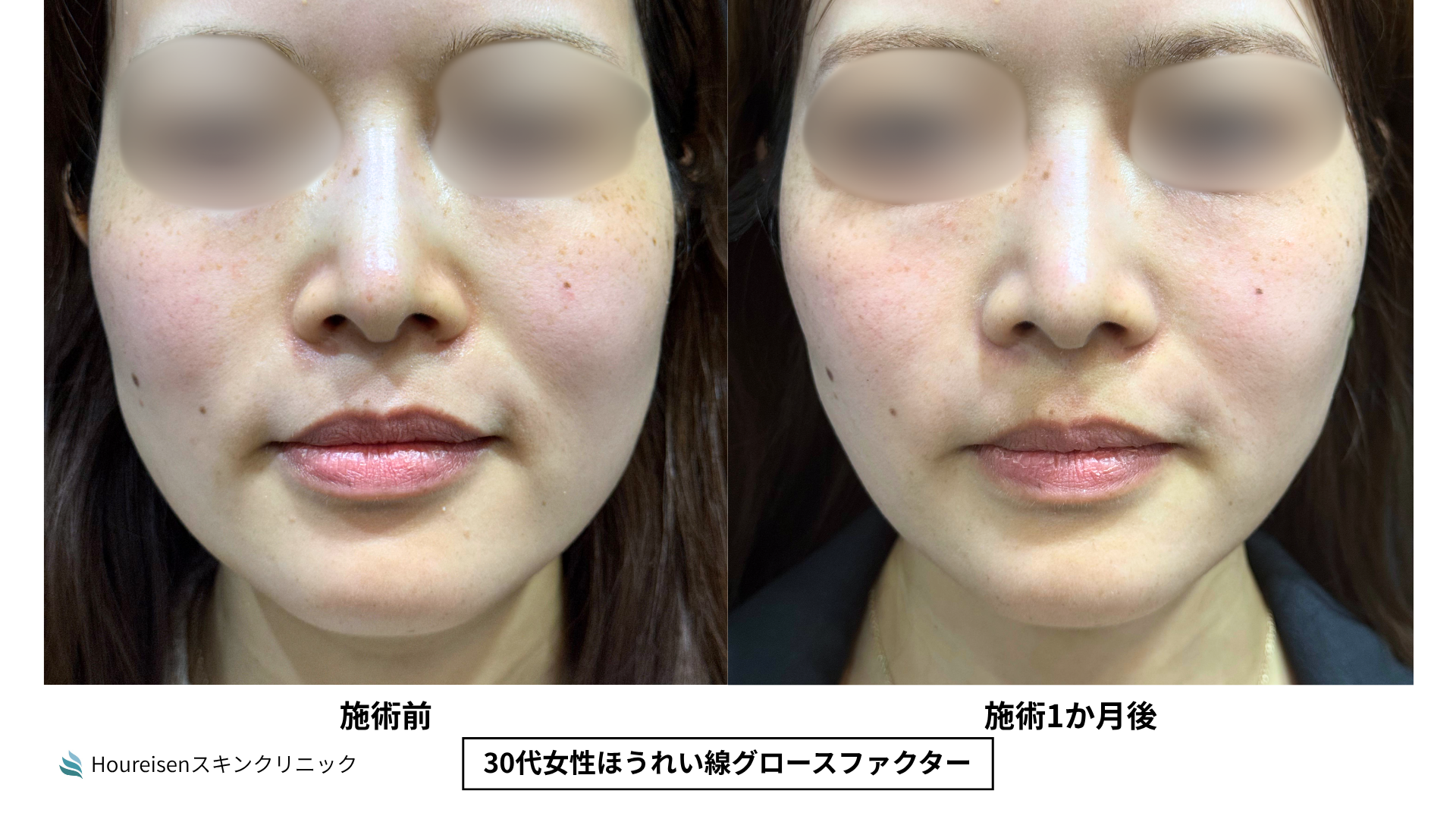 30代女性 ほうれい線グロースファクター治療前と1か月後