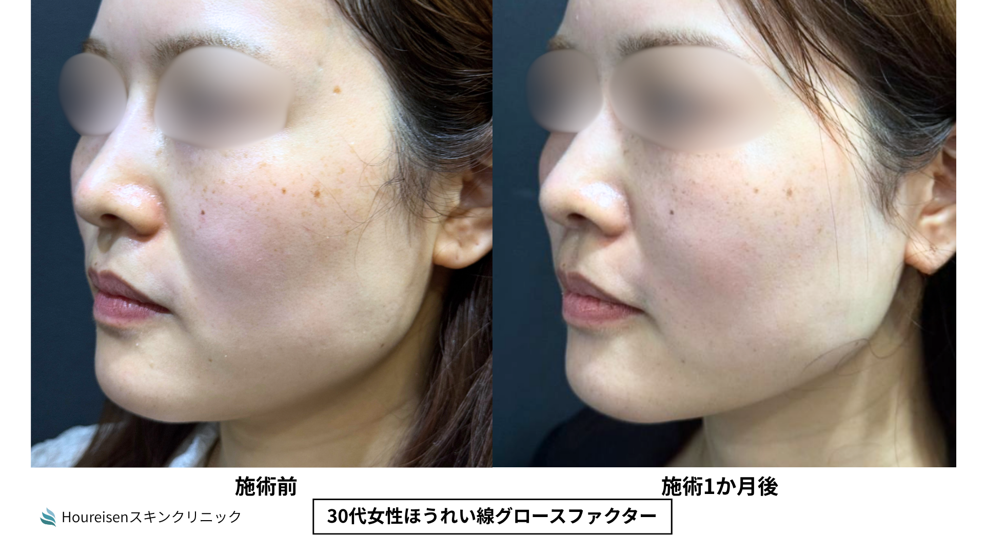 ほうれい線治療 症例比較