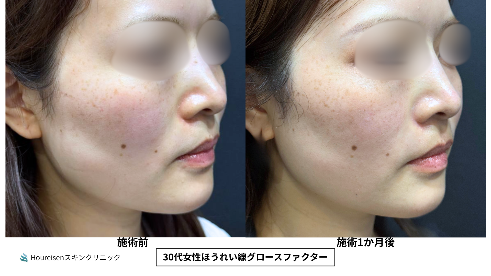 ほうれい線治療 症例比較