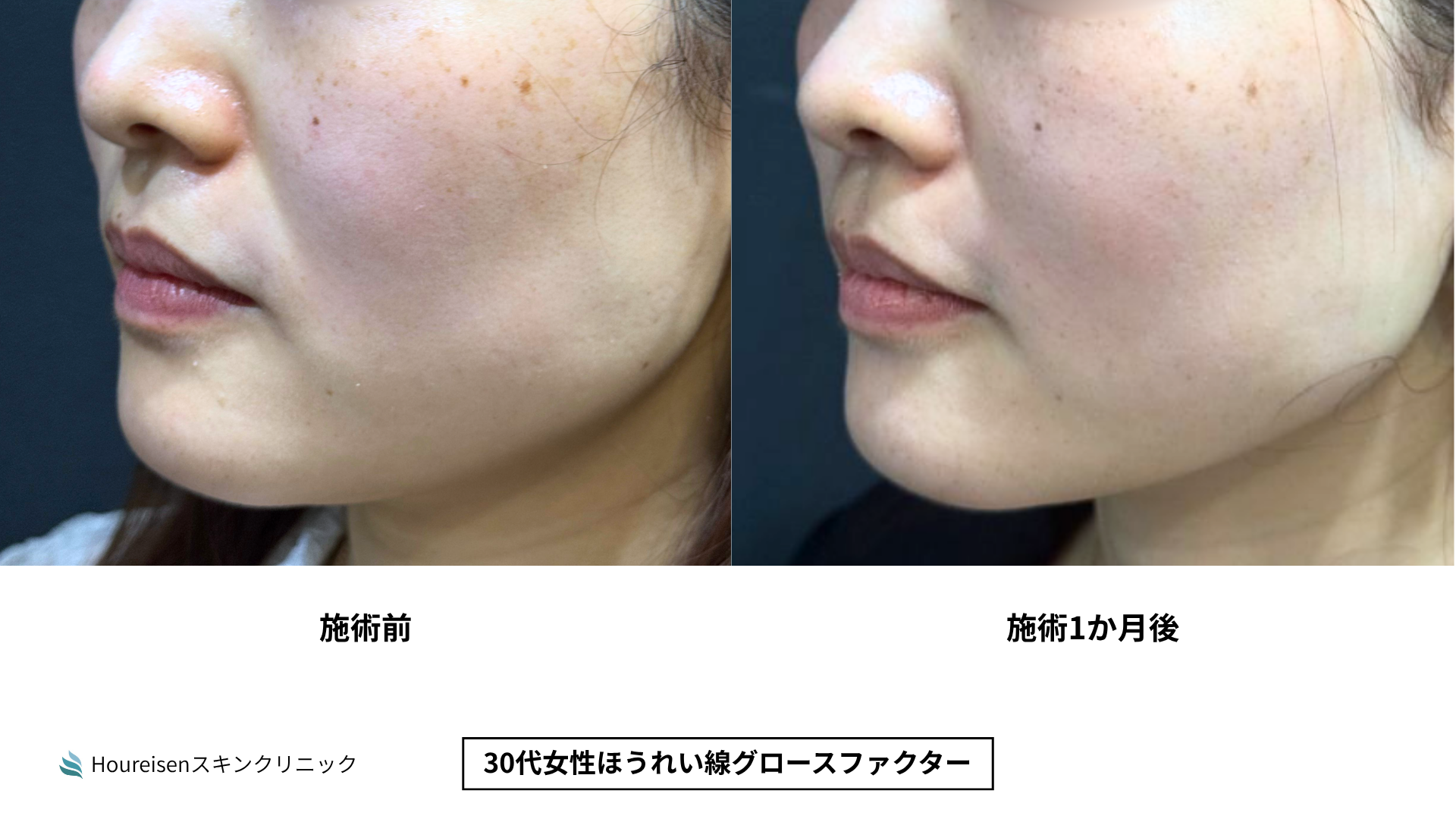 ほうれい線治療 症例比較